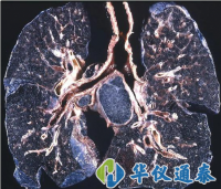 你知道什么是塵肺病嗎?使用粉塵儀可以降低塵肺病的發(fā)生率